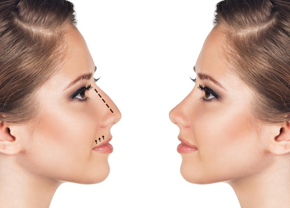 Nasenkorrektur Koln Rhinoplastik Septorhinoplastik Beethoven