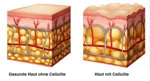 Cellulite Grafik 