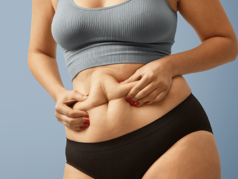 Lipödem am Bauch und Symptome der Fettverteilungsstörung am Bauch