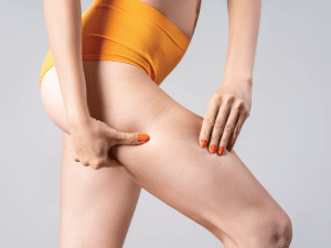 Cellulite oder Lipödem - wo ist der Unterschied? Beethoven Klinik Köln.