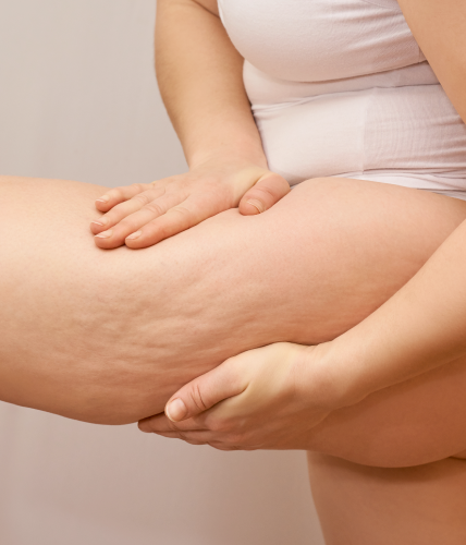 Lipodem OP Koeln Frauenbein