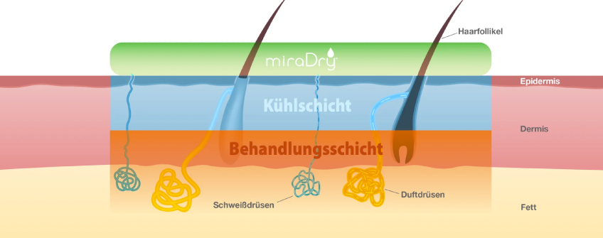 Miradry gegen Hiperhidrose Hautschichten