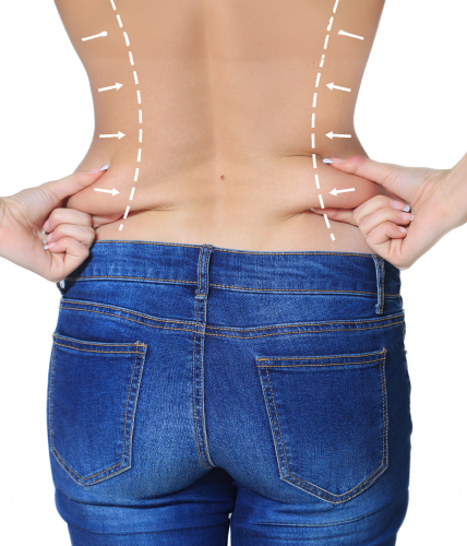 Lipofilling vorteile frau mit seitenfett